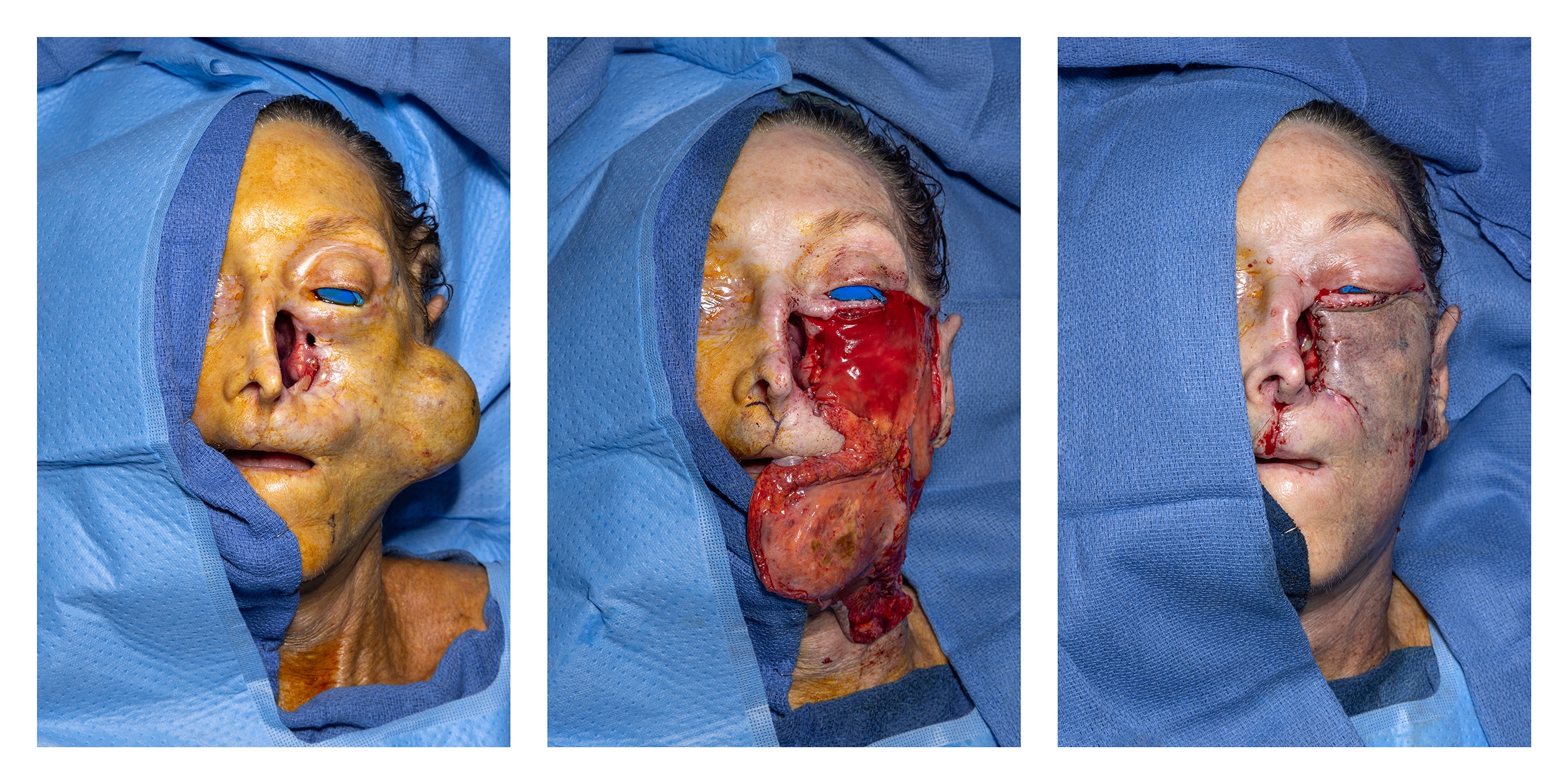 Skin Expander Removal for Facial Reconstruction Surgery<