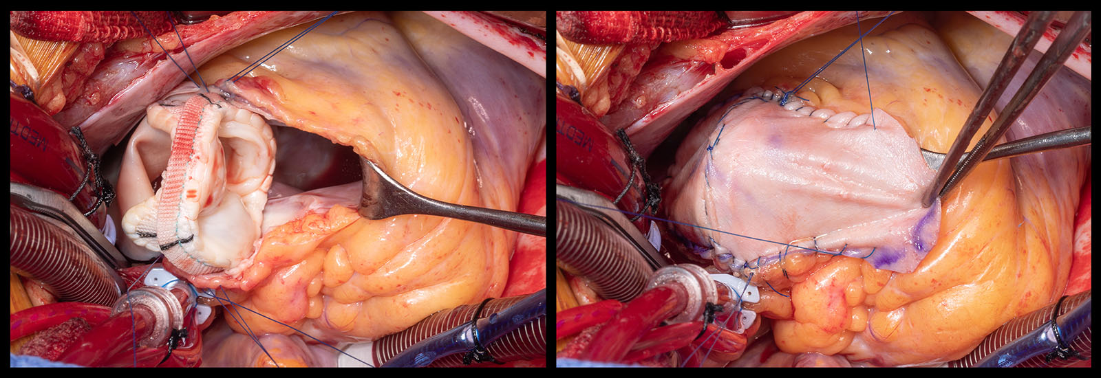 Atrial Septum Closure © Taylor Parker